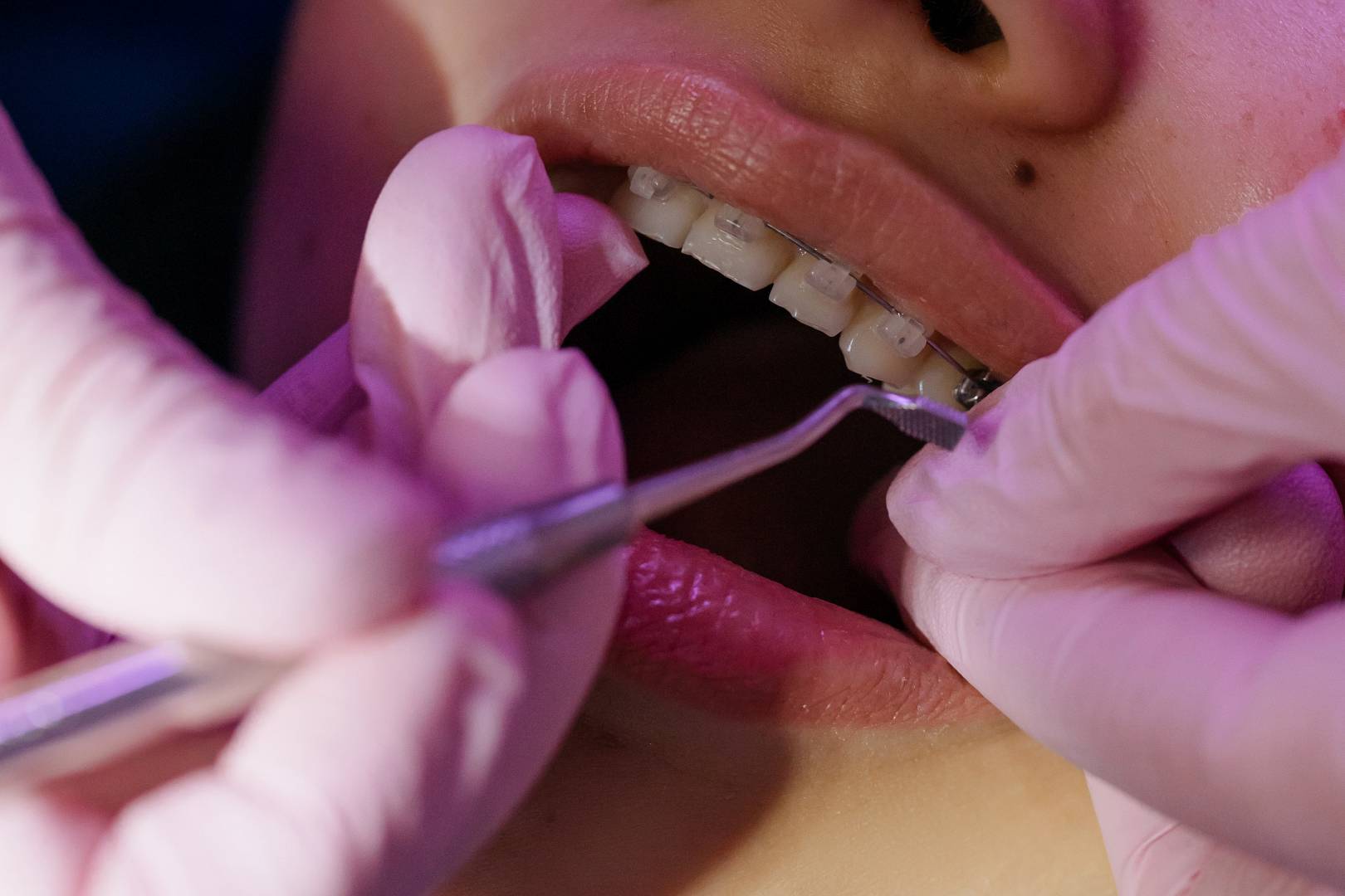 Aparaty ortodontyczne – czy stanowią przeszkodę w wybielaniu zębów?